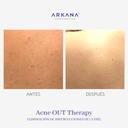 acne-out-therapy-espalda-acne-antes-y-después-arkanaspain.jpg