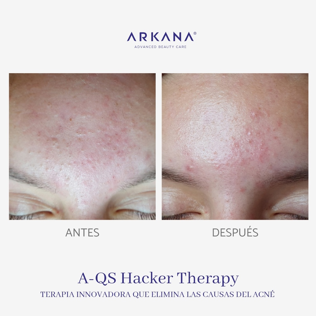 a-qs-hacker-therapy-acné-frente-antes-y-después-arkanaspain.jpg