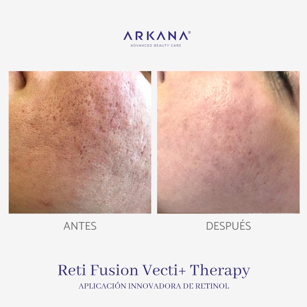 reti-fusion-vecti-therapy-arkanaspain-aplicacion-innovadora-de-retinol-mejilla-poros-antes-y-despues.jpg