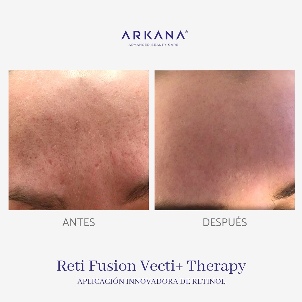 reti-fusion-vecti-therapy-arkanaspain-aplicacion-innovadora-de-retinol-frente-antes-y-despues.jpg