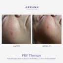 prp-therapy-arkanaspain-terapia-que-rejuvenece-y-remodela-la-piel-totalmente-antes-y-despues-mejillas-labios.jpg
