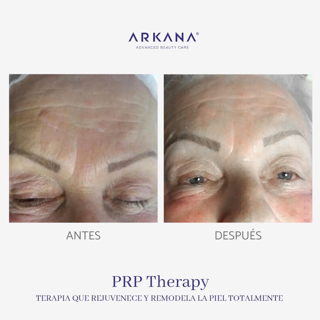 prp-therapy-arkanaspain-terapia-que-rejuvenece-y-remodela-la-piel-totalmente-antes-y-despues-frente.jpg