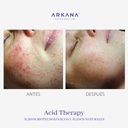 acid-therapy-acne-acne-antes-y-después-arkanaspain.jpg