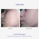 acid-therapy-acne-antes-y-después-arkanaspain.jpg