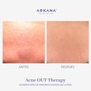 acne-out-therapy-acne-antes-y-después-arkanaspain.jpg